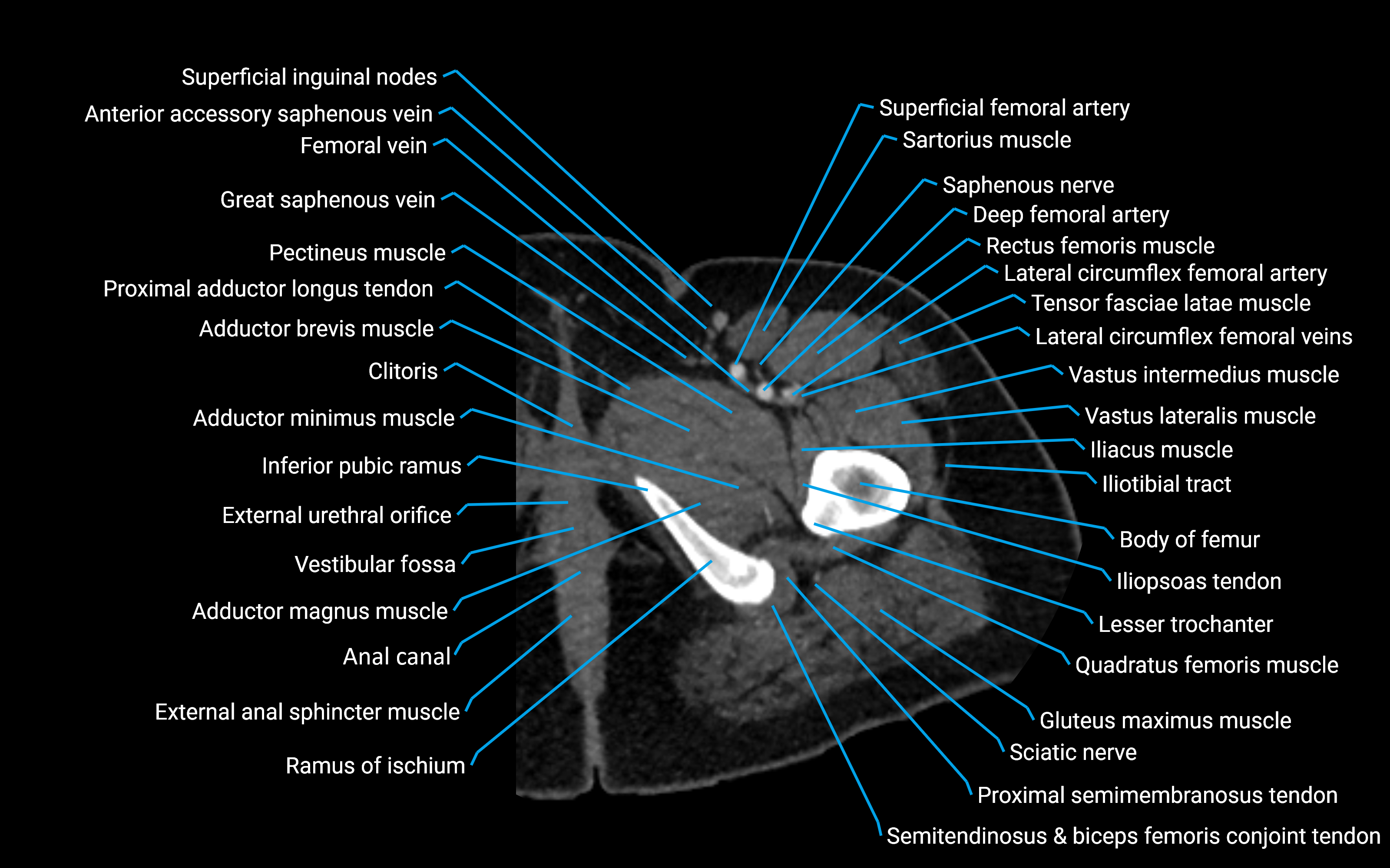 CT Hip axial cross sectional anatomy labelled image 17 (2).png